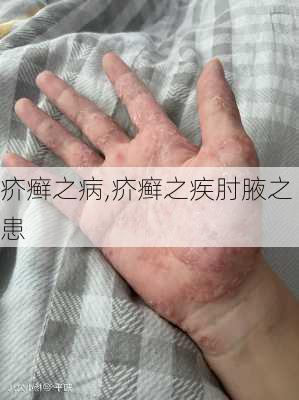 疥癣之病,疥癣之疾肘腋之患