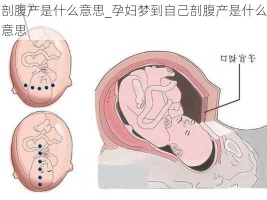 剖腹产是什么意思_孕妇梦到自己剖腹产是什么意思